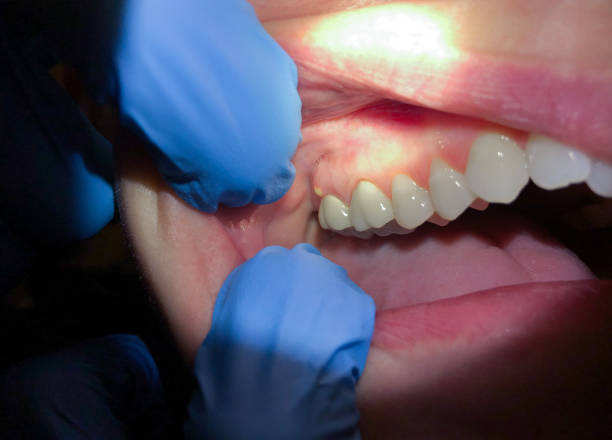 Best Emergency Treatment for Oral Infections in Ladue, MO